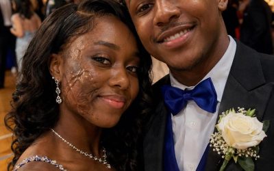 A Boy Asked Me to Dance at Prom Because No One Else Would Due to My Scars – The Next Day, His Parents and Officers Showed up at My Door – Daily Stories