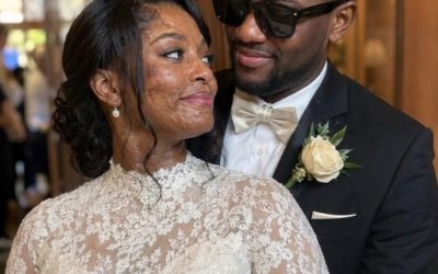 I Married a Blind Man So He’d Never See My Scars – On Our Wedding Night, He Said, ‘You Need to Know the Truth I’ve Been Hiding for 20 Years’